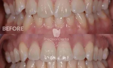 Clear Aligner Orthodontics Clinical Case in Murarrie