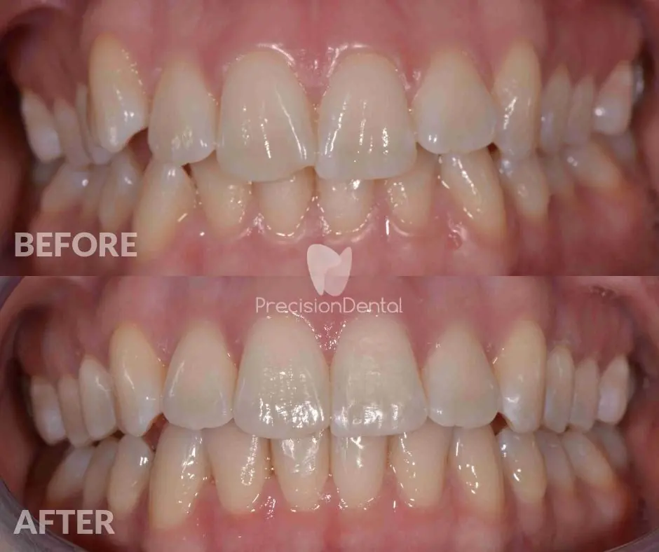 Clear Aligner Orthodontics Clinical Case in Murarrie
