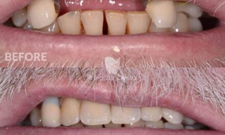 Dental Implant Rehabilitation Clinical Case in Redland Bay