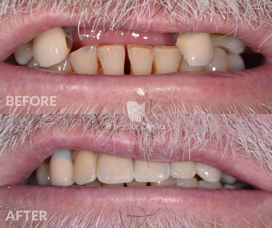 Dental Implant Rehabilitation Clinical Case in Redland Bay