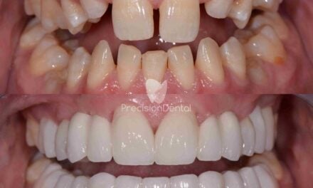 Full Mouth Rehabilitation Clinical Case in Slacks Creek