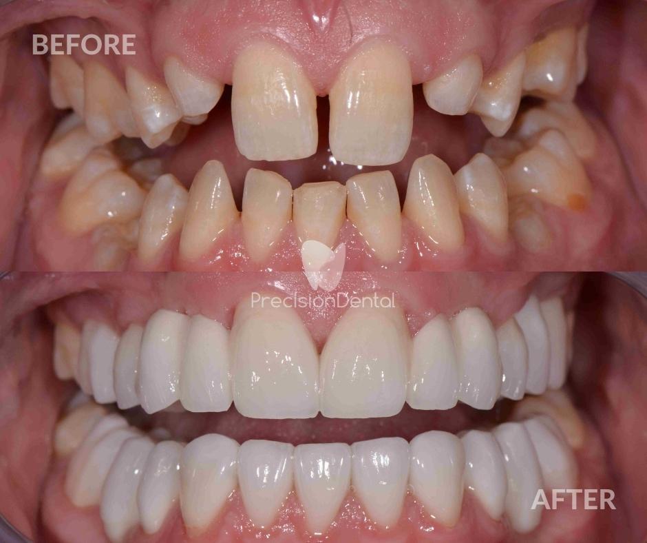 Full Mouth Rehabilitation Clinical Case In Slacks Creek George's Full Mouth Rehabilitation in Slacks Creek Brisbane, Fortitude Valley - Precision Dental
