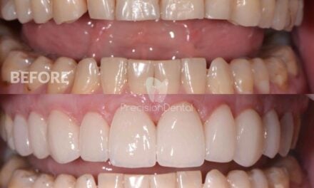 Porcelain Veneer Rehabilitation Clinical Case in Northgate