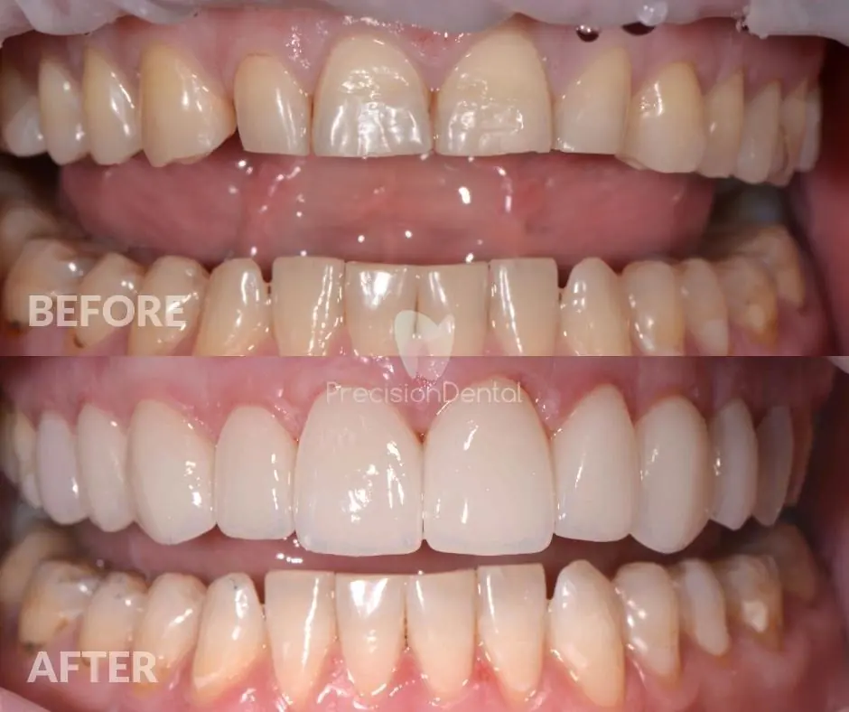 Porcelain Veneer Rehabilitation Clinical Case in Northgate