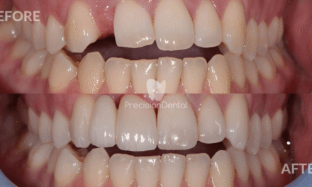 Anterior Crown and Bridge Restoration Clinical Case in Fortitude Valley