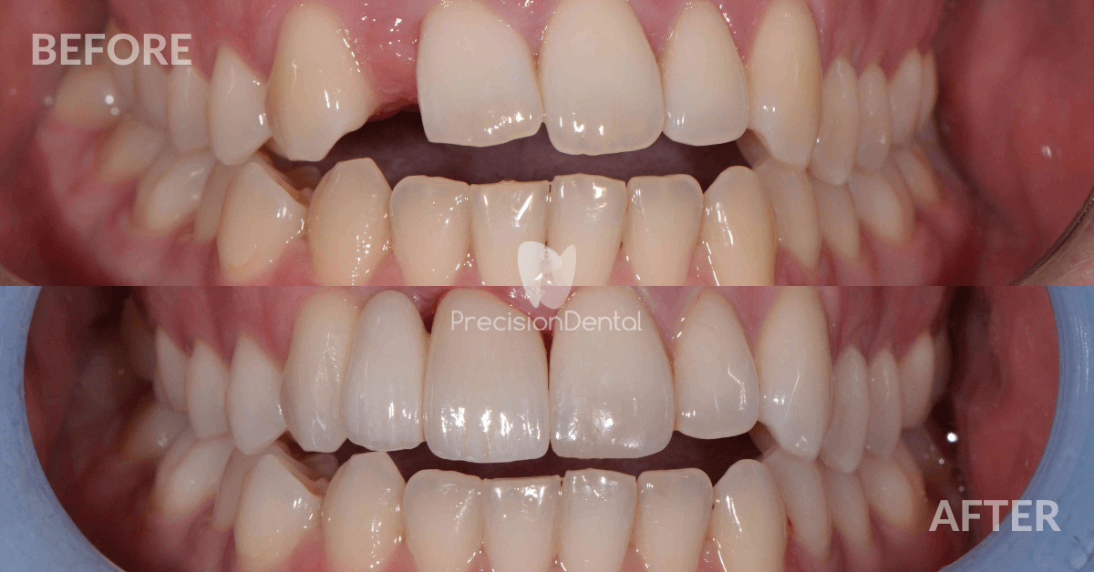 George's Full Mouth Rehabilitation in Slacks Creek Brisbane, Fortitude Valley - Precision Dental