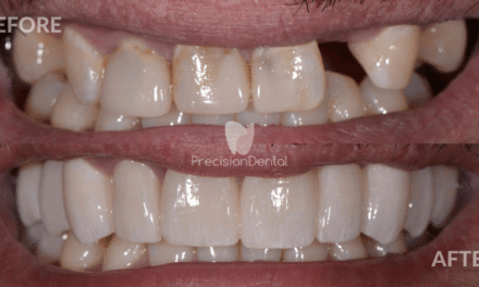 Full Mouth Rehabilitation Clinical Case in Fortitude Valley