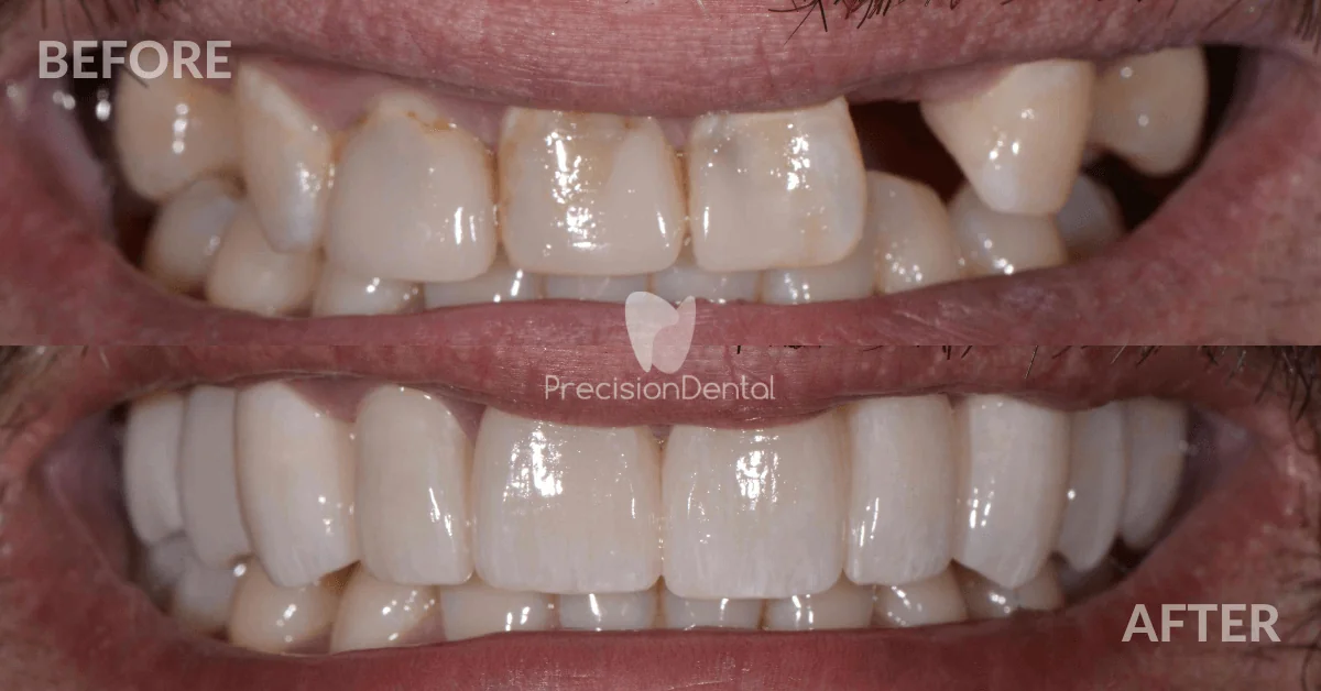 Full Mouth Rehabilitation Clinical Case in Fortitude Valley