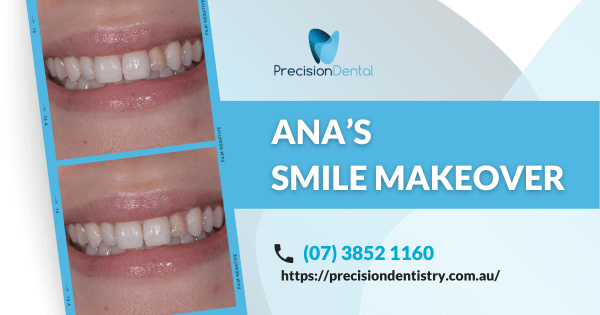 Ana of Fortitude Valley’s Porcelain Veneer Makeover