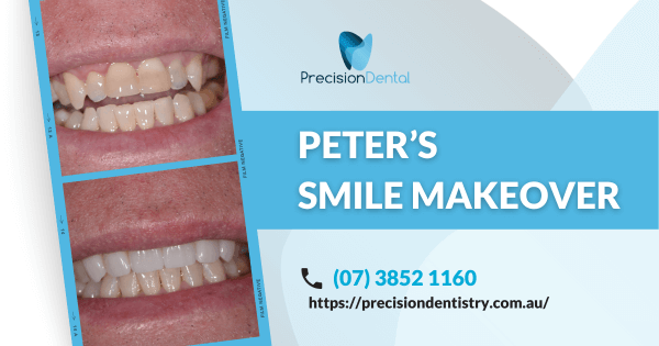 Peter of Fortitude Valley’s Dental Crowns Makeover