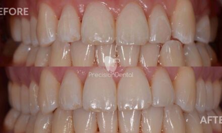 Clear Aligner Crowding Treatment Clinical Case in Brisbane