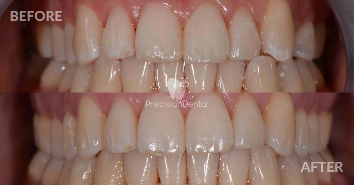Clear Aligner Crowding Treatment Clinical Case in Brisbane