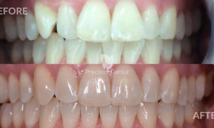 Clear Aligner Therapy Clinical Case in Brisbane
